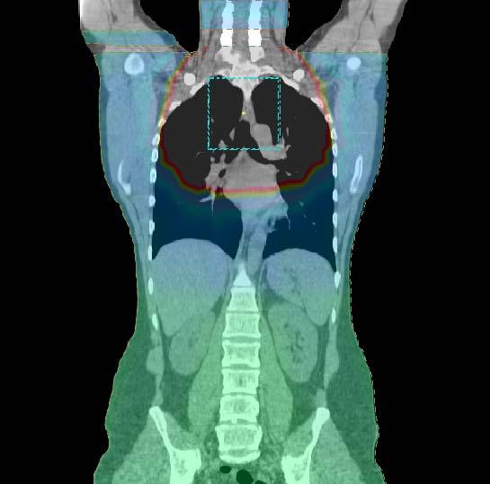 Målvolum lungene, relativt moderat feltstørrelse og 2 Gy x 25 fraksjoner CT skannet?