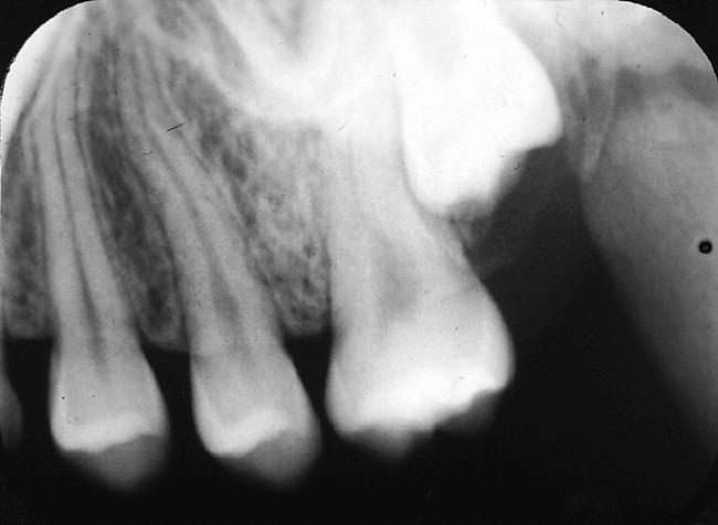 Primær retensjon. Dette vil si at erupsjonen av en normalt posisjonert og normalt utviklet tann som ikke har brutt gjennom gingiva hindres, selv om det ikke foreligger noen fysisk barriere (Fig. 3).