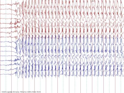 Generalisert spike wave 3 /sek Typisk for abscense epilepsi Hypsarytmi (100 mv/cm) EEG er uryddig Målet med behandlingen