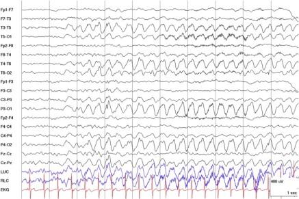 Oppsummering Epilepsi er en klinisk diagnose og betegner en tilstand med tendens tilsynelatende spontane anfall EEG er et nyttig hjelpemiddel i diagnostikk Barn