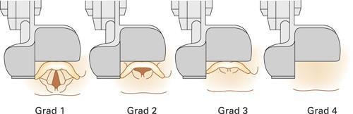 Kjernejournal vil inneholde mulighet for å registrere: Intubasjonsproblem Gradering av anatomisk tilgjengelighet for intubasjon (Cormack & Lehane) 1. Grad 1: Stemmebånd synlig 2.