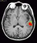 Funksjonell MR (fmri) Avbilder oksygenforbruket mens man gjør opptaket. Kan f.