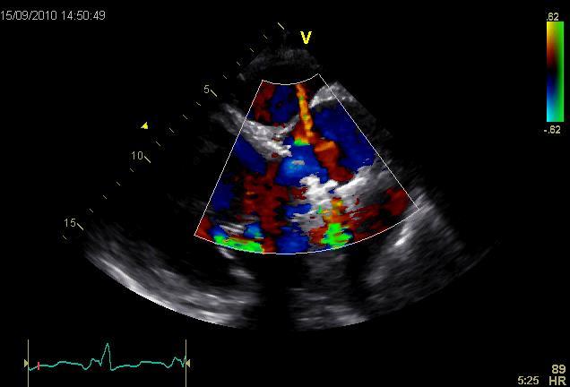 - Endocarditt?