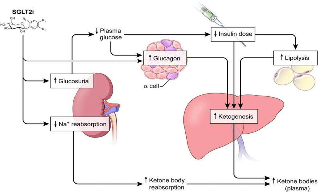 SGLT2-h kan predisponere mot ketoacidose J Clin