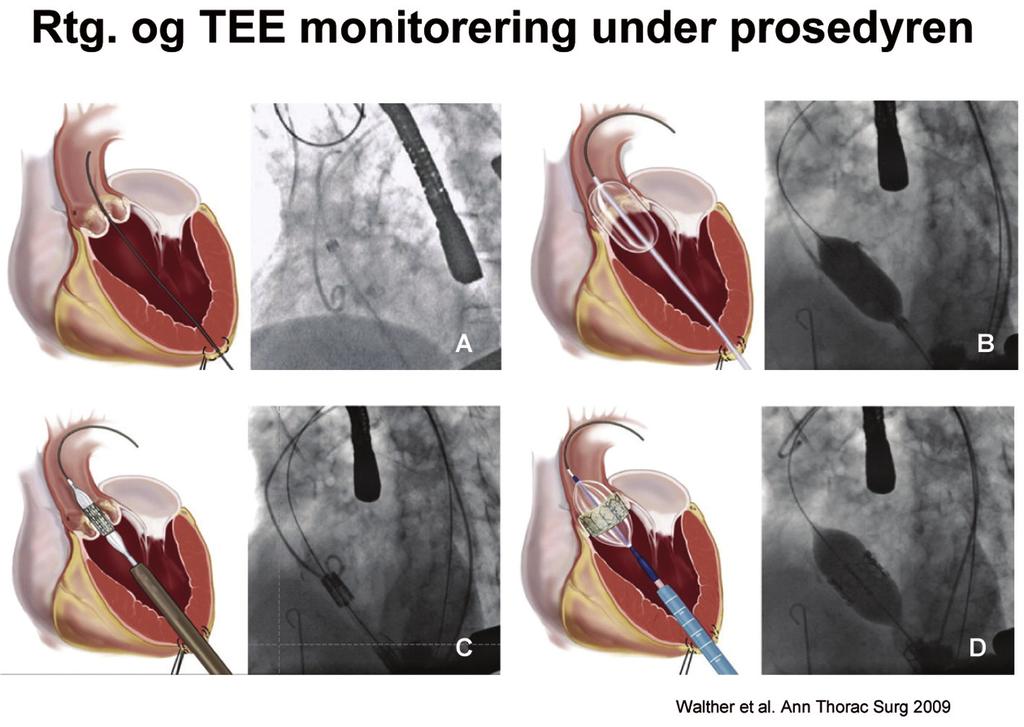 98 Figur 2 viser transapical implantasjon steg for steg. Figuren er modifisert fra referanse 9 ledewire antegrad gjennom aortaklaff. Wiren legges langt ned i aorta descendens.