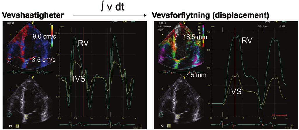 Vevshastigheter har vært tilgjengelig i ca. 10 år. Målt enten ved pulset doppler eller ved fargevevsdoppler (5) får man fremstilt regionale longitudinelle vevshastigheter (figur 4).