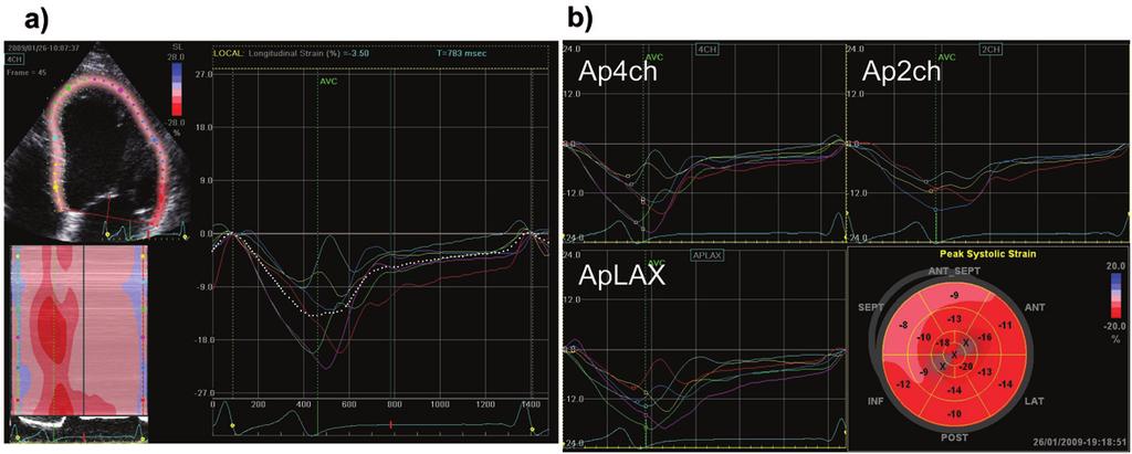 78 av gjennomsnittlig maksimalt systolisk strain for hvert segment som også får en fargekode (figur 5b).