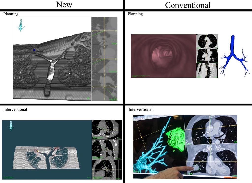 Páll Jens Reynisson Bruk av navigasjonsteknologi i kombinasjon med 3Dmodeller fra røntgenbilder overvinner delvis vanskelighetene med minimalt invasive inngrep, som for eksempel reduksjon av