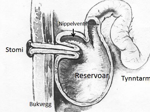 KONTINENT ILEOSTOMI Kontinent ileostomi (fig.3) er en tett (kontinent) ileostomi Det betyr at den ikke lekker ut tynntarmsinnhold ufrivillig og kontinuerlig.