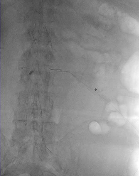 Covidien Nitrex-18 wire,