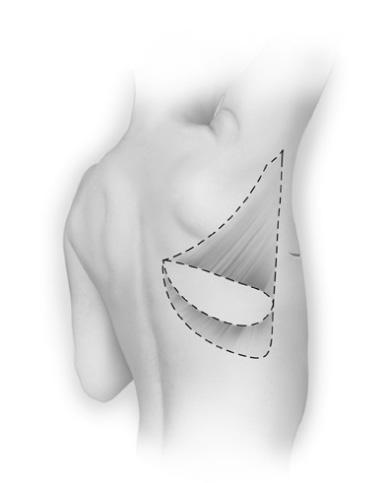 11662-03 17 Latissimus dorsi-lapp med eller uten brystimplantater En hudlapp og muskel tas fra giverstedet i ryggen. Vevet føres i tunnel til mastektomien og brukes for å skape en brystmasse.