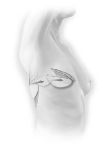 Fordi latissimus dorsilappen vanligvis er tynnere og mindre enn TRAM-lappen, kan denne prosedyren være mer egnet for å rekonstruere et mindre bryst.