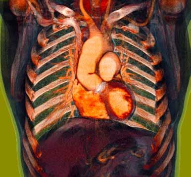 Et fargelagt CT-bilde av brysthulen (toraks).