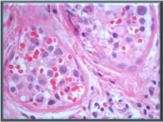 KASUS 9: Diagnoseforslag Intravaskulært lymfom: 4