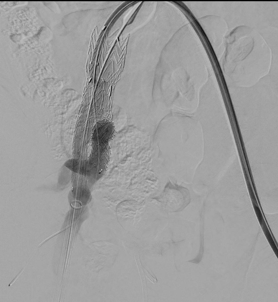 Prosedyren Høyre side Internabenet er utløst, over en hydrofil wire med bøyd tupp. Internadelingen er ikke dekket over.