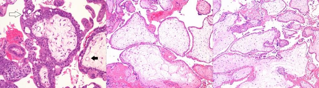 Resultater Fallgruber ved klassifikasjon av trofoblastsykdommer Hydrop abort diagnostisert som komplett mola av student og partiell mola av patolog Merk: Atypi med vakuoler (hvit pil) Kapillærer