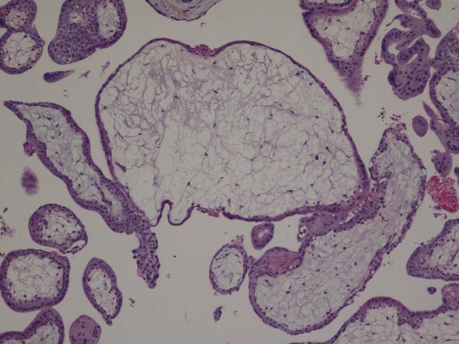 Konklusjon Diagnosen ved trofoblastsykdommer, med