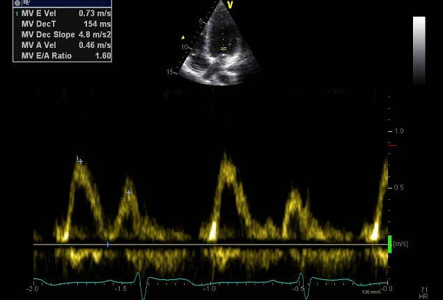 Doppler E DT A Mitralflow E (m/s) Edt