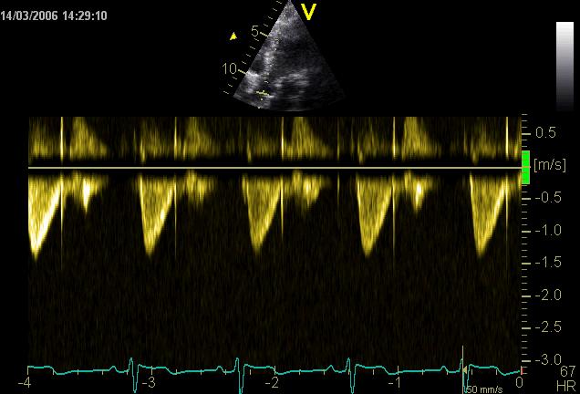 Doppler S D LVOT,