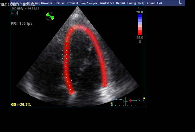 2D ekkokardiografi, postprosessering: Regional