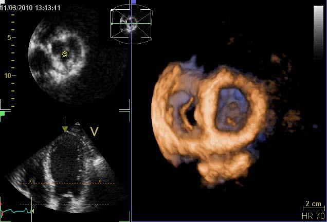 3D ekkokardiografi: AV