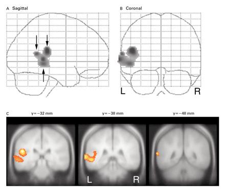 Tinnitus en ekte fantom-lyd.