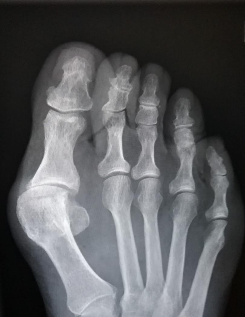 Langtkommen artrose i MTP 1. I dette tilfelle ved Hallux valgus. Beskriv: Varusvinkling av 1.