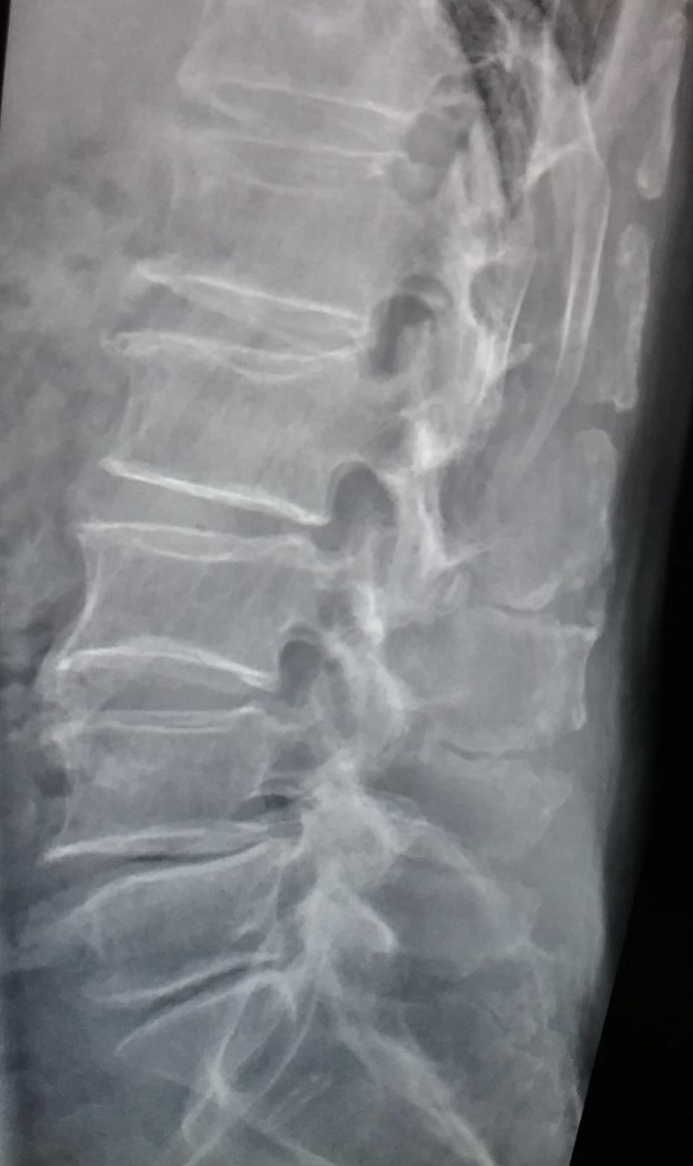 Skivesammenfall + spondylose = «osteokondrose» dertil