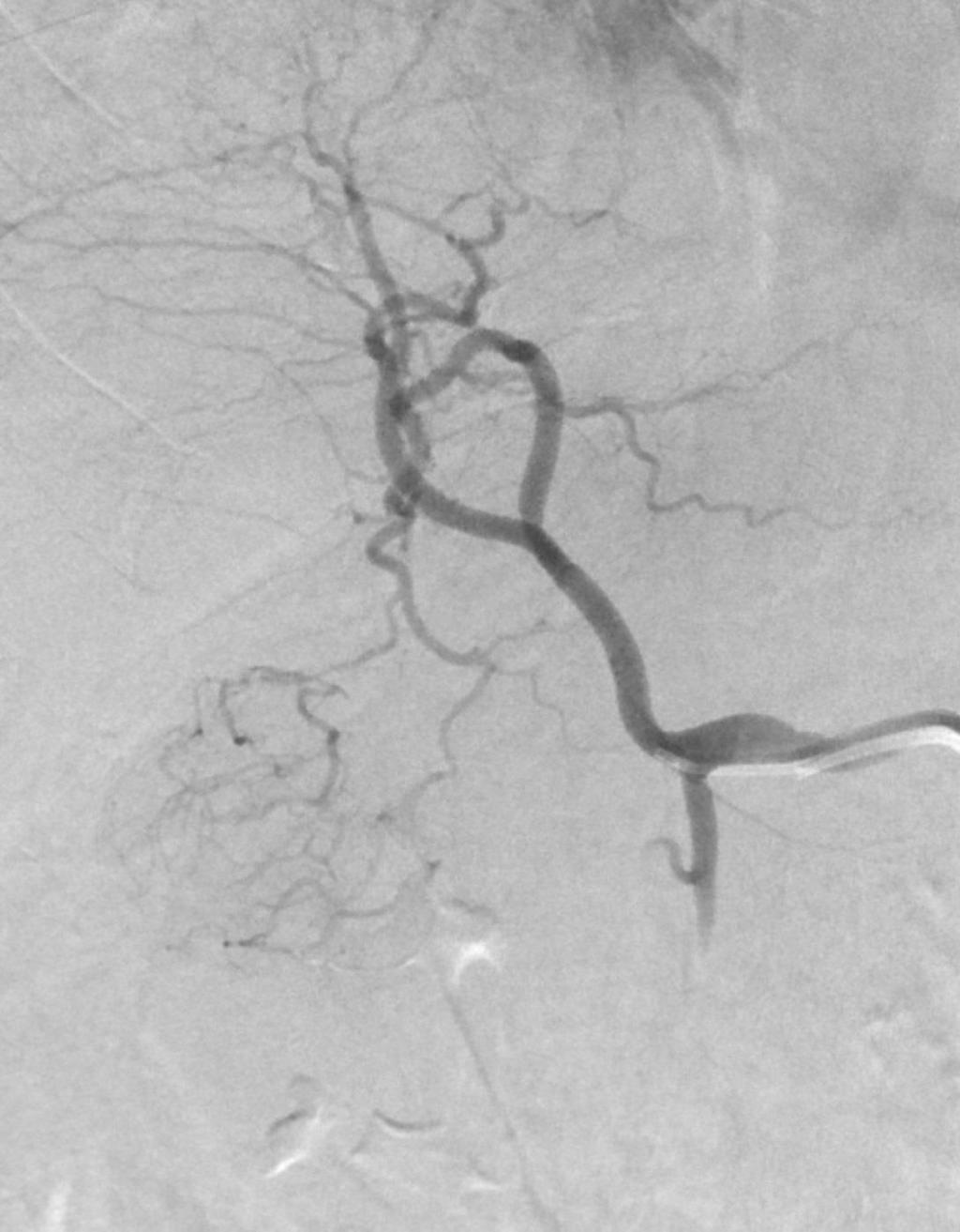 Rtg. Arteriografi Lever med intervensjon Retrograd punksjon i høyre arteria