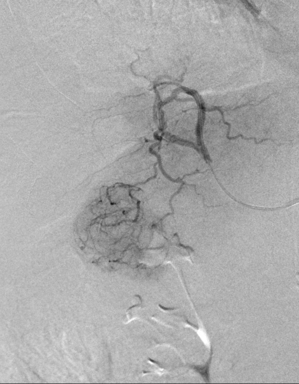Rtg. Arteriografi Lever med intervensjon Angiografi fremstiller en sterkt kontrastladende lesjon caudalt i venstre