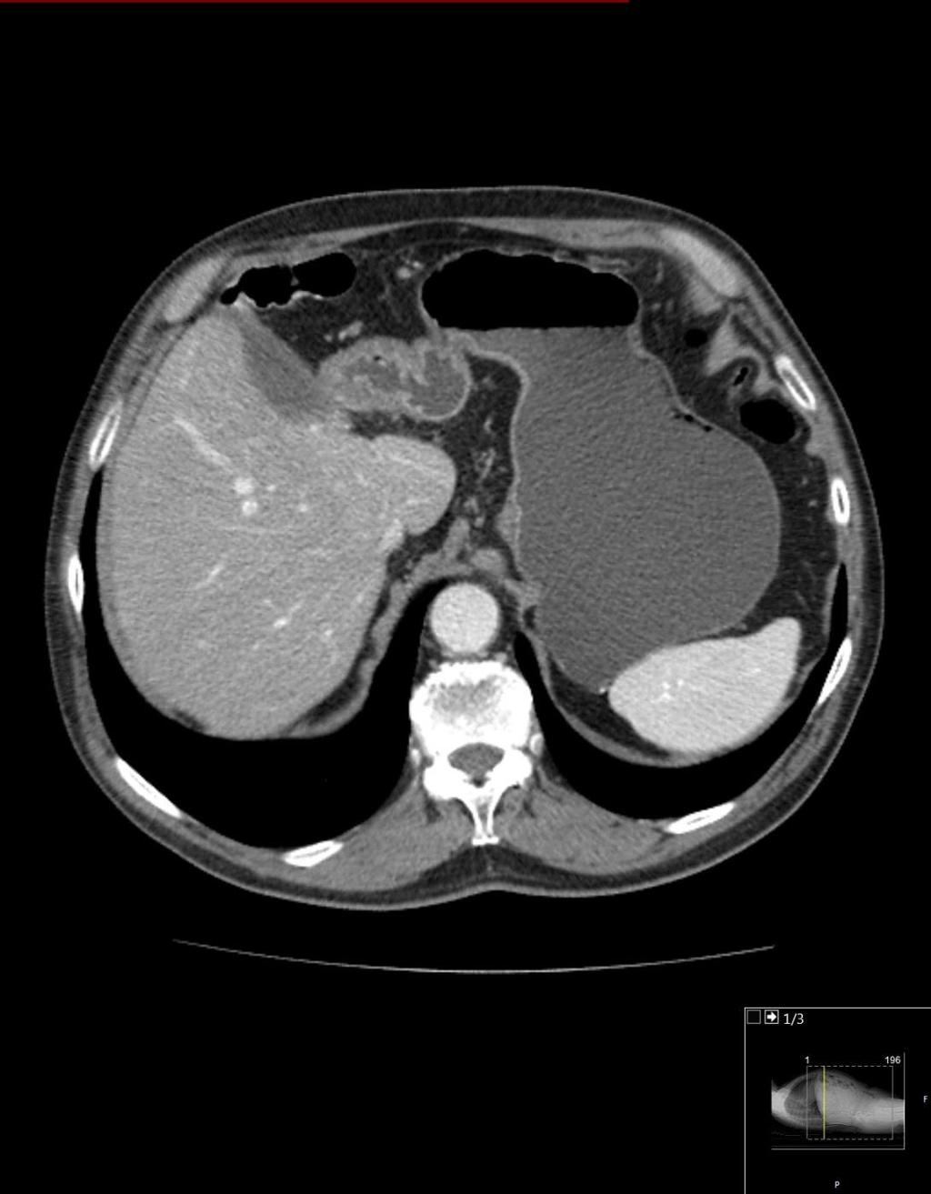 CT abdomen etter fjerning av venstre leverlapp: