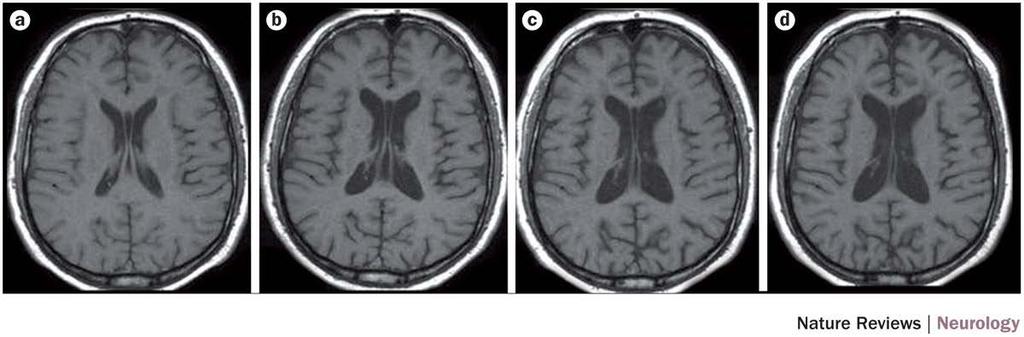 Serial T1-weighted MRI scans in a patient with multiple sclerosis Wattjes, M. P. et al.