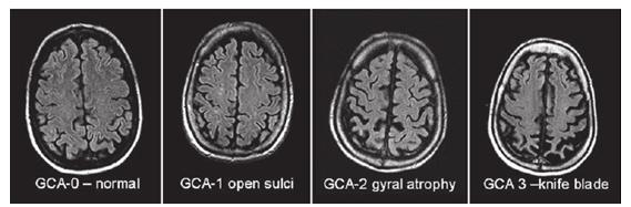 Kortikal atrofi (GCA) Grade 0 = ingen atrofi Grade 1 = lett utvidelse av sulci uten synlig volumtap i