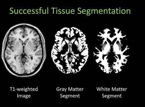Data analyser Ofte: segmentering av grå/ hvit substans og CSF til adskilte volumer Annet: