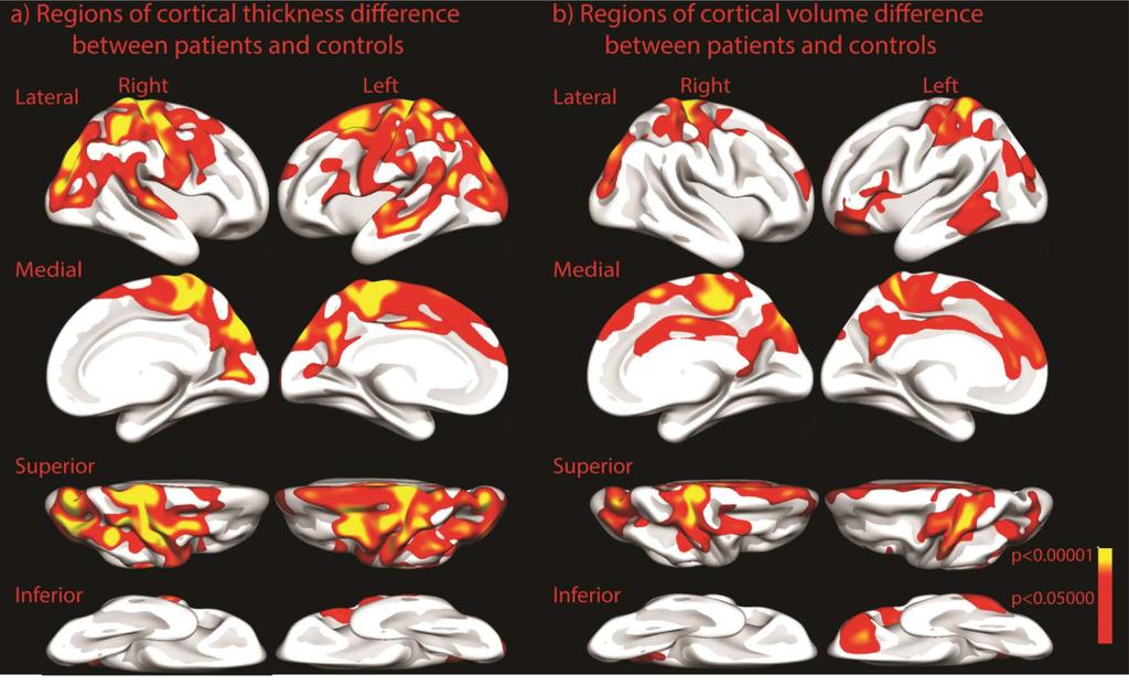 Like sekvenser muliggjør gruppesammenligninger Cortical thickness and surface