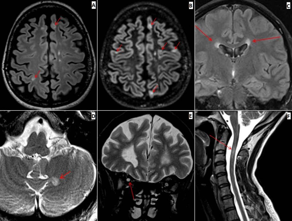 MS diagnose Disseminering i ROM (SPACE) Lesjon(er) i minst to MS-spesifikke Periventrikulær Kortikal/Juxtacortical