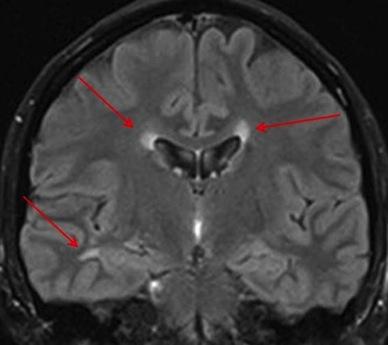 gi forenklet total nr lesjoner (<10, 10-20, >20) Er det tegn til atrofi? Evt. andre funn / bifunn Passer generelt radiologisk utseende med MS?