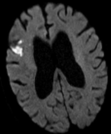 Biologisk aortaklaff