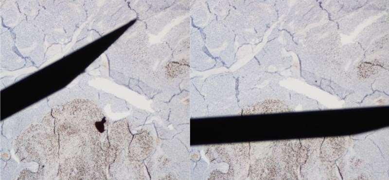 Testingen er nærmest som å kaste terning (Marius Lund Iversen, patolog) Lysbildet til venstre viser en biopsi-nål i en svulst som bommer helt på området i svulsten som