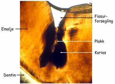 TEMA: KARIES - FOREBYGGENDE TILTAK OG BEHANDLING Fig. 4: Slipesnitt av tann med fissurforsegling over en karieslesjon begrenset til emaljen. mikrobene i biofilmen.