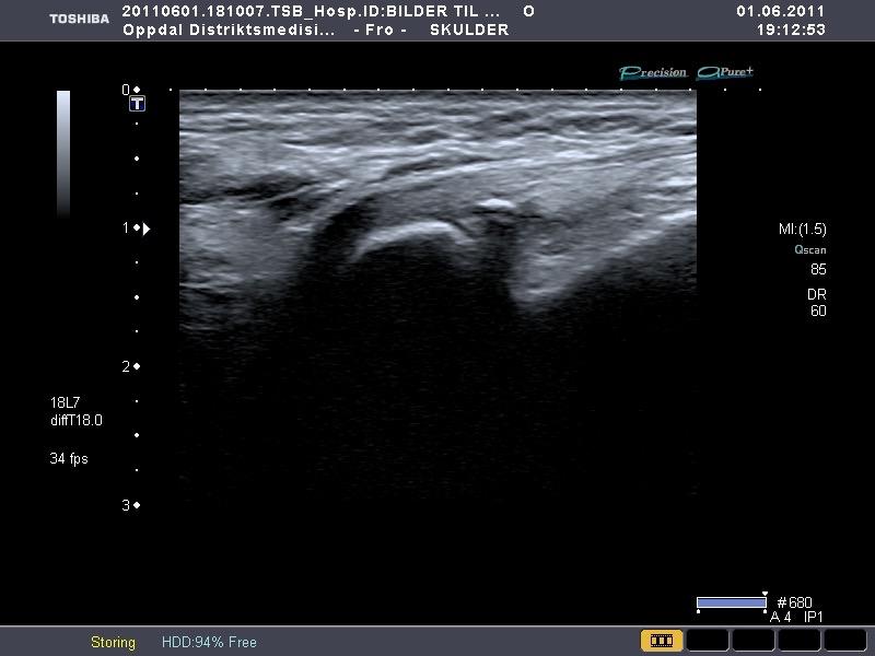 Fallgruber og anatomiske varianter Os peroneum Antatomisk variant.