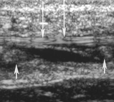 Plantarissene Fallgruber og anatomiske varianter ca 90% av befolkning har denne strukturen.