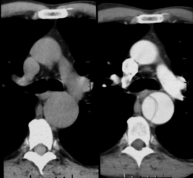 CT aorta, teknikk Tilstrekkelig mengde kontrastmiddel iv.