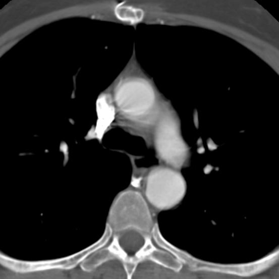 CT aorta, teknikk Tilstrekkelig mengde kontrastmiddel iv.