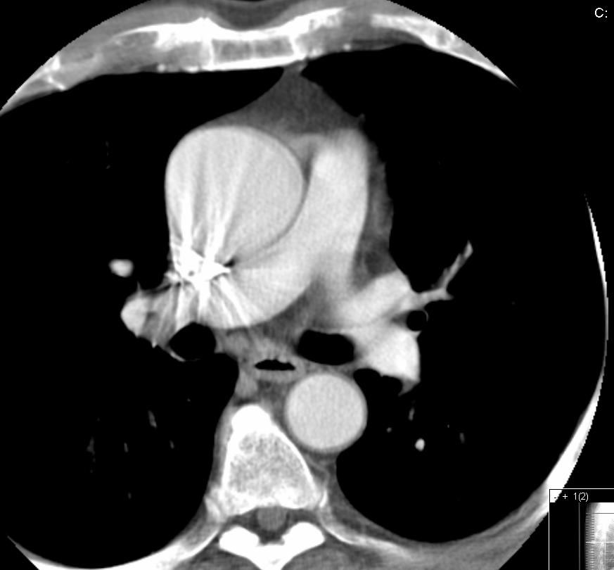 CT aorta, teknikk Tilstrekkelig