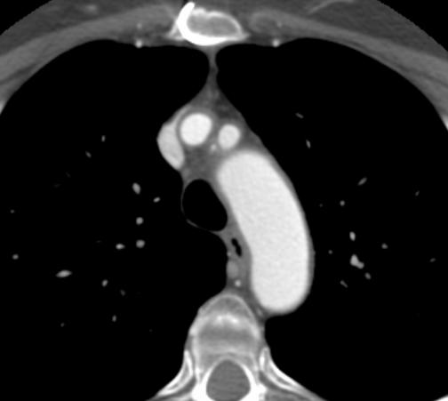 CT aorta, teknikk Tilstrekkelig mengde kontrastmiddel iv.