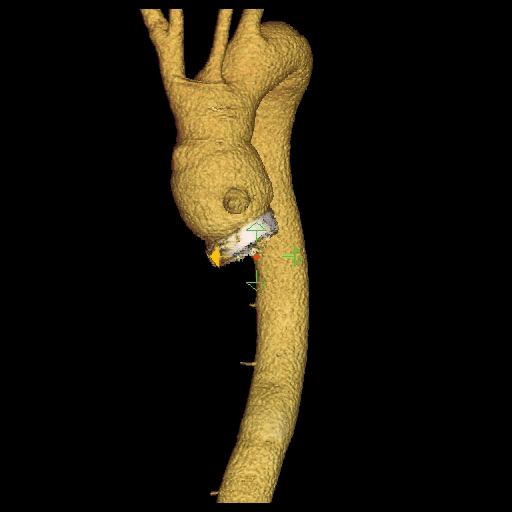 CT aorta