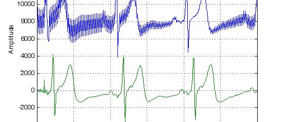 Transient: EKG - Før og etter filtrering Eks fra første forelesing Se nøyere på starten av det filtrerte signalet.