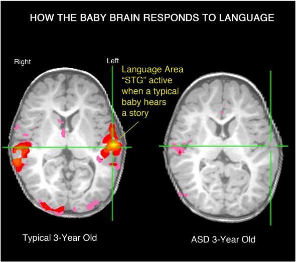 FMRI: Bildet viser aktiveringen av