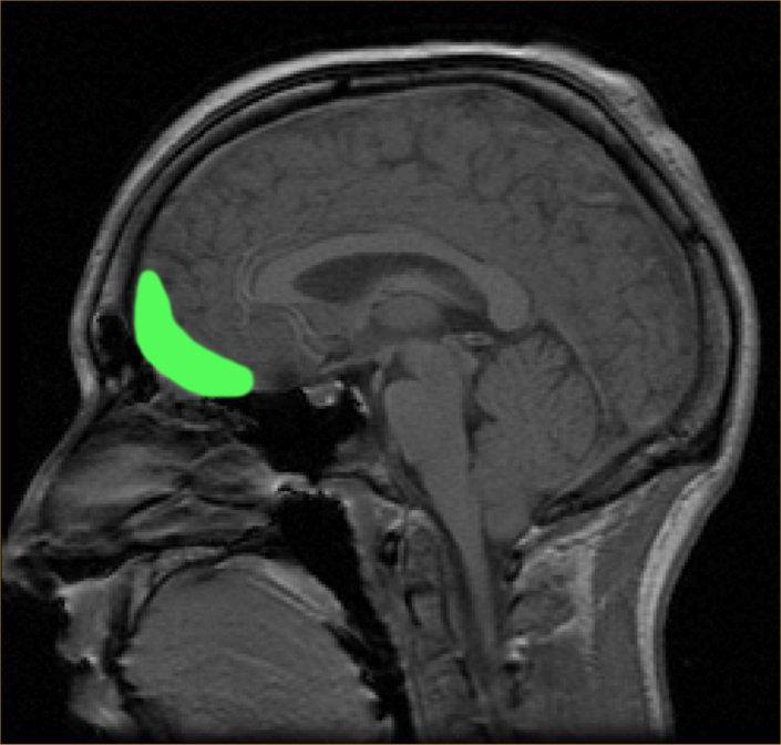 Orbitofrontal cortex Intuitiv forståelse og handling (Schwartz et al.